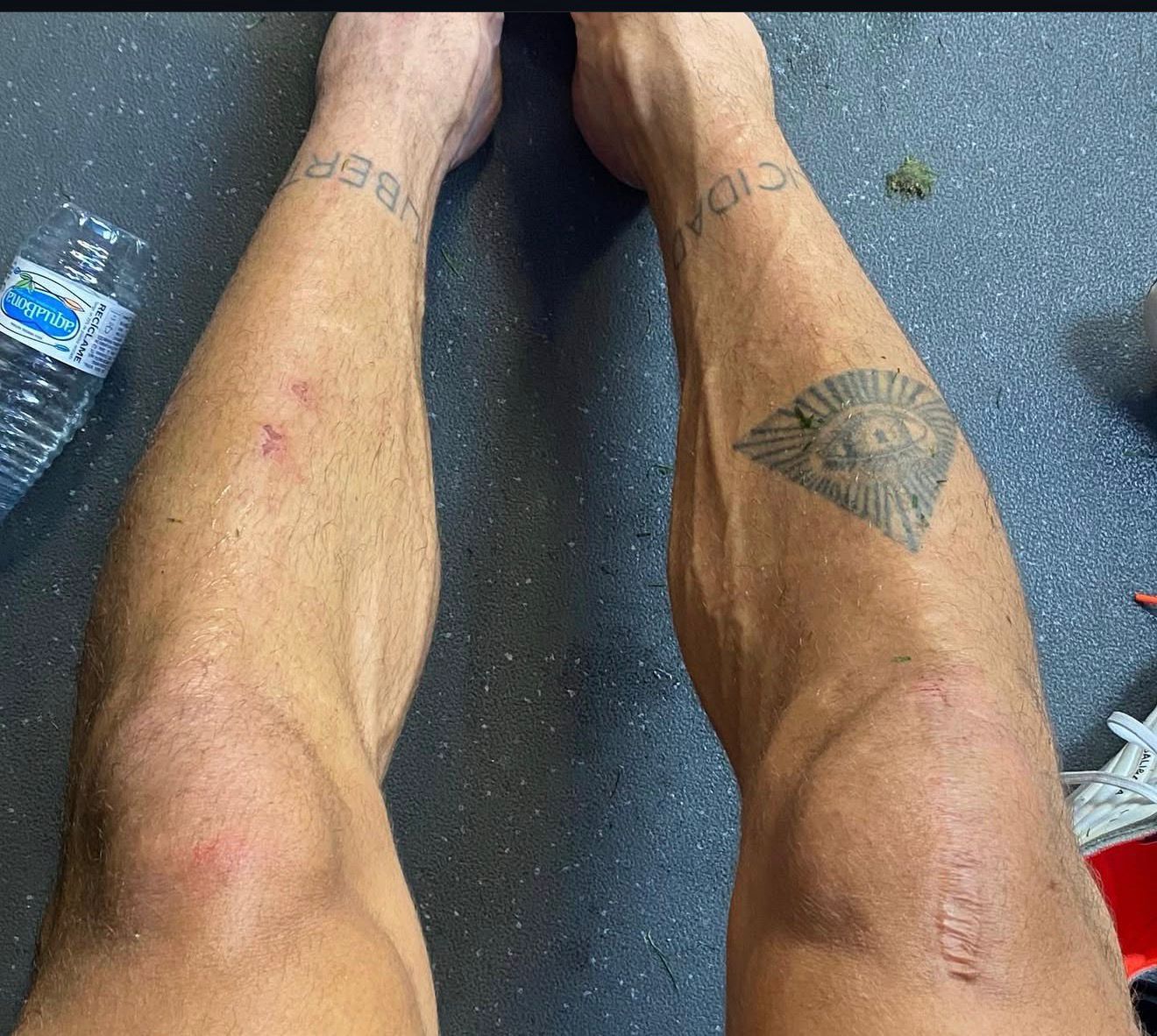 La rodilla operda de Piccini.